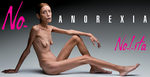 Anorexia.jpg